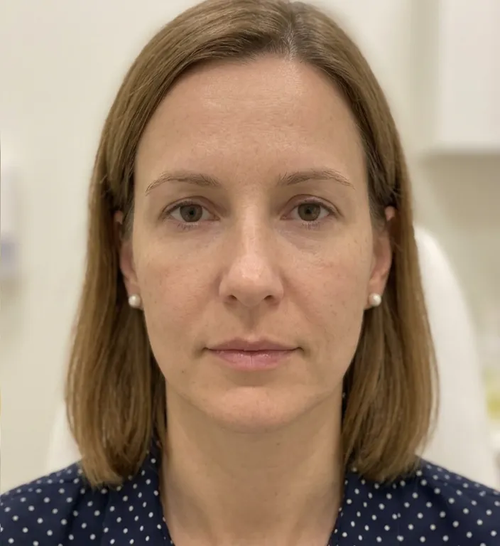 Nasolabial fold after