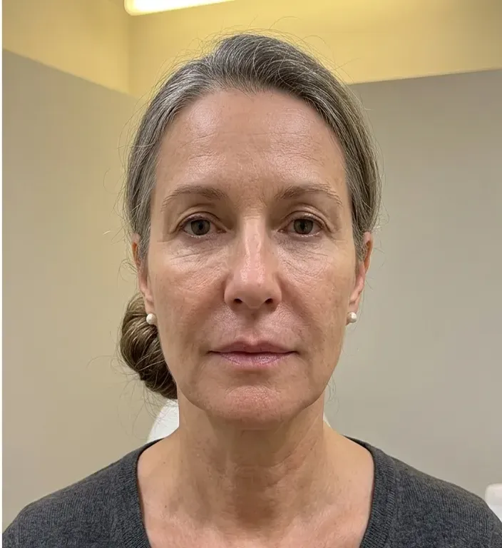 Nasolabial fold after