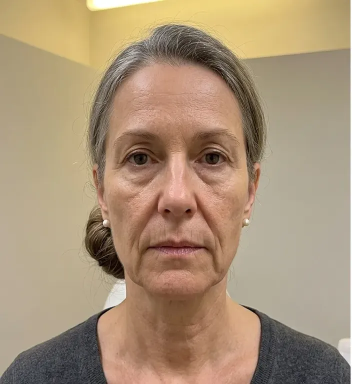 Nasolabial fold before